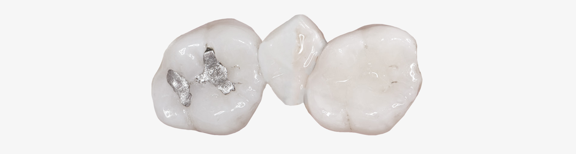 Zwei Zähne, links mit Metallfüllung, rechts ohne.